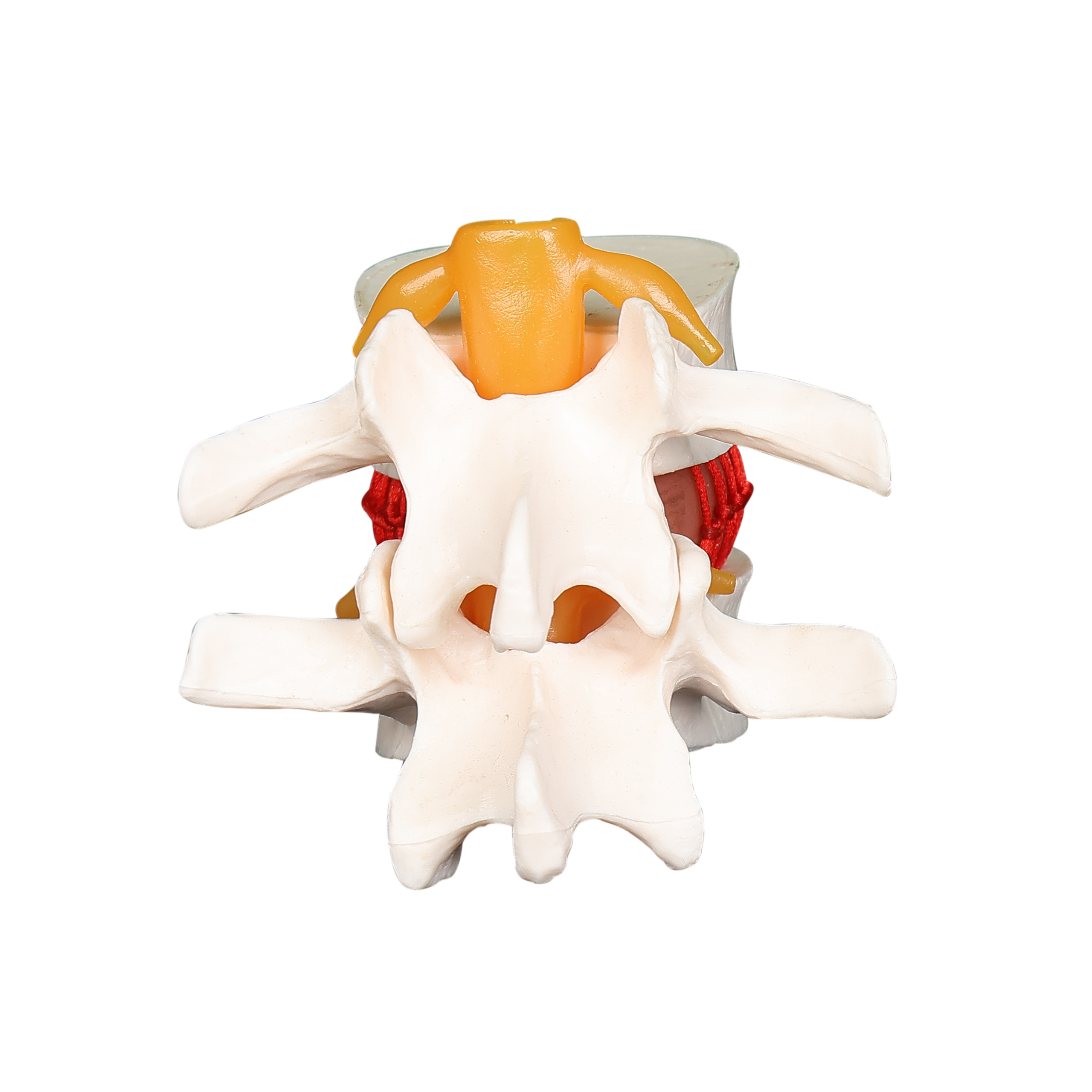 Spine Vertebral disc herniation prolapse model
