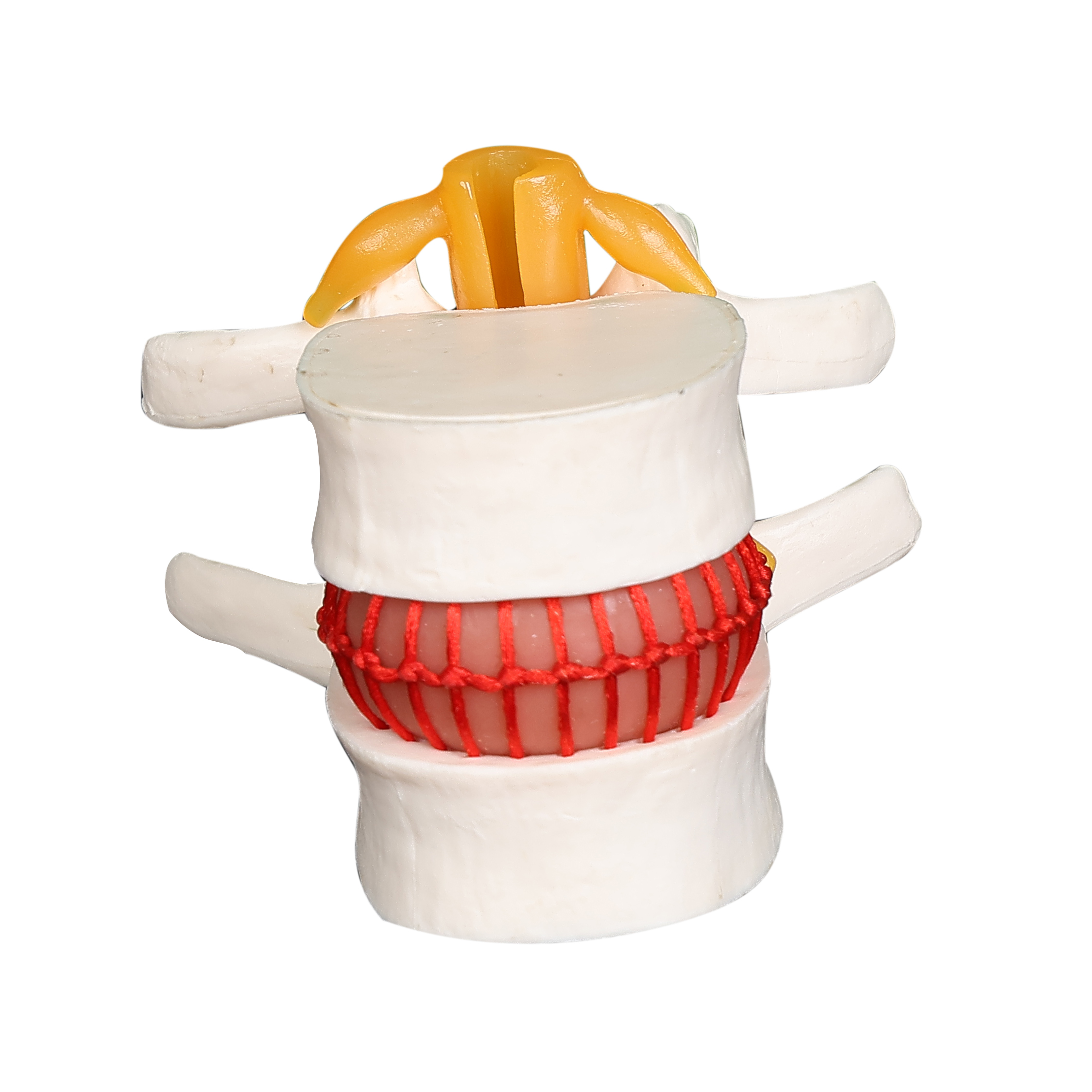 Disc herniation model of spine vertebrae