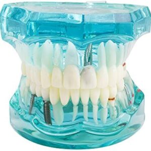 Transparent Dental Implantation Tooth Model