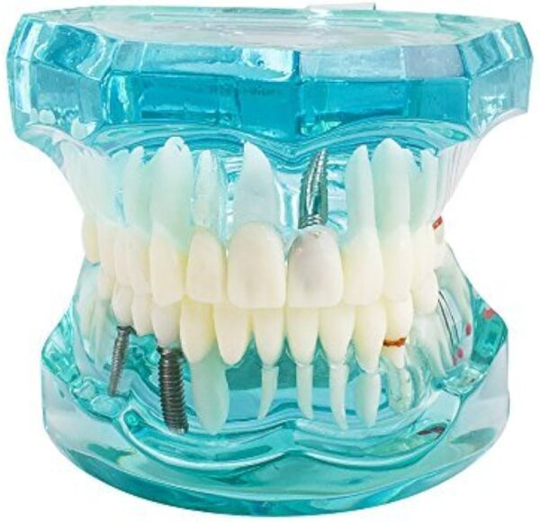 Transparent Dental Implantation Tooth Model