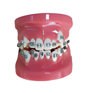 Fixed Orthodontic Model (Dislocation)