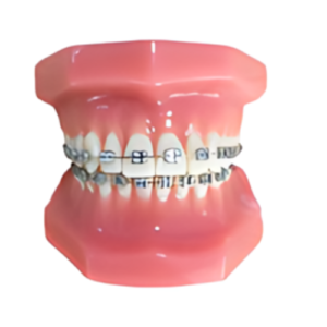 Fixed Orthodontic Model (Normal)