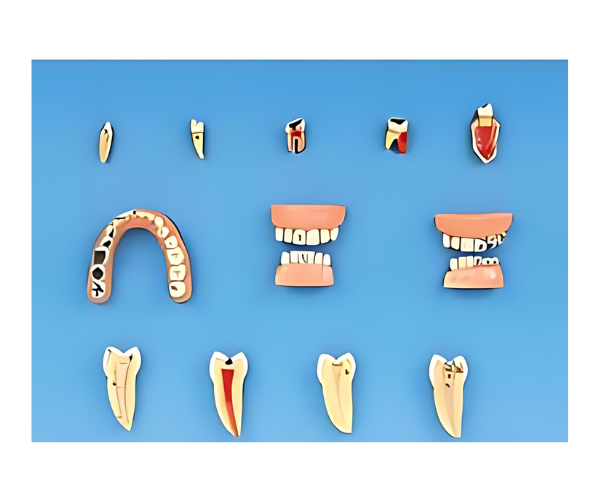 Dental Diseases Model Dental Diseases Model