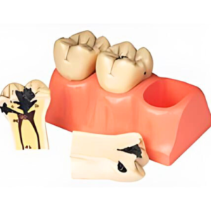 Dissected Model of Dental Caries