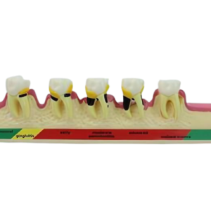 Periodontal Disease Model